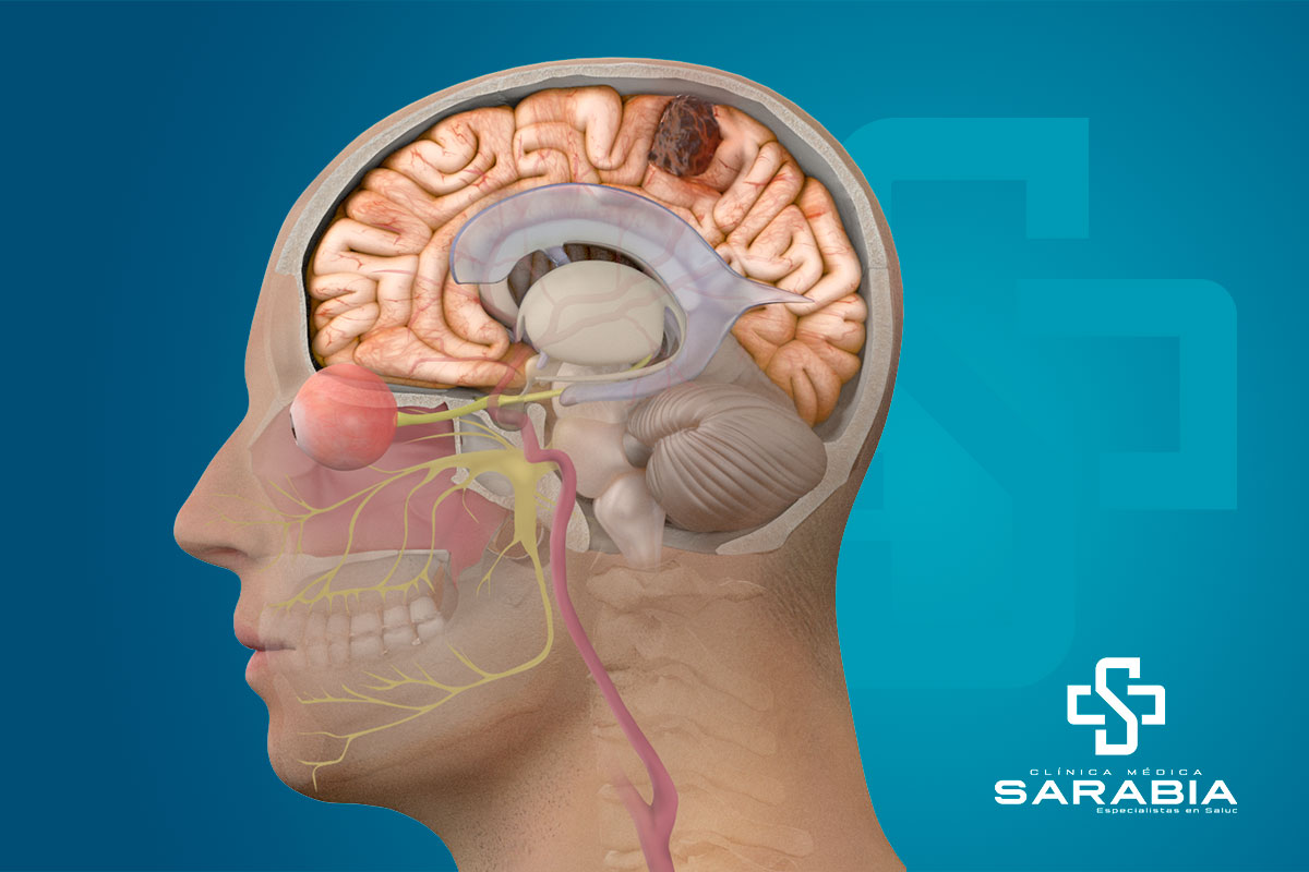 Neurocirugía de Clínica Sarabia encarga del diagnóstico y tratamiento quirúrgico de enfermedades del sistema nervioso central y periférico