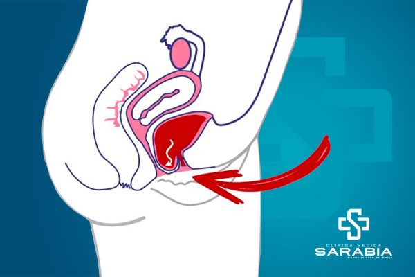 Colpoplastia tehuacan ginecologo especialista