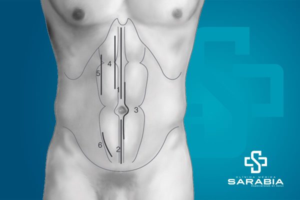 laparotomia tehuacan especialista clinica sarabia