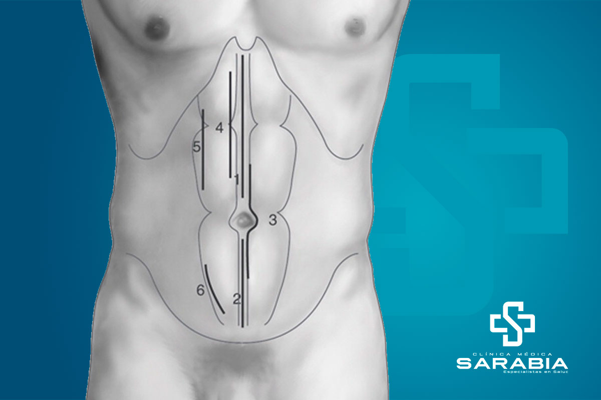 laparotomia tehuacan especialista clinica sarabia
