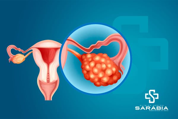 tehuacan cirugia de Ooforectomia clinica sarabia