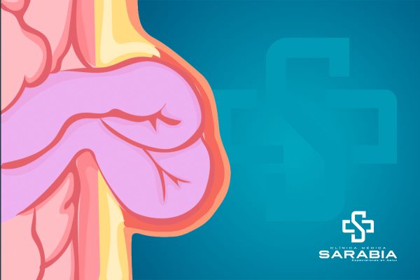 Cirugia de Hernia tehuacan clinica sarabia