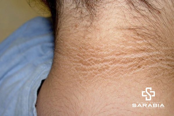 Acantosis Nigricans consulta en Tehuacan