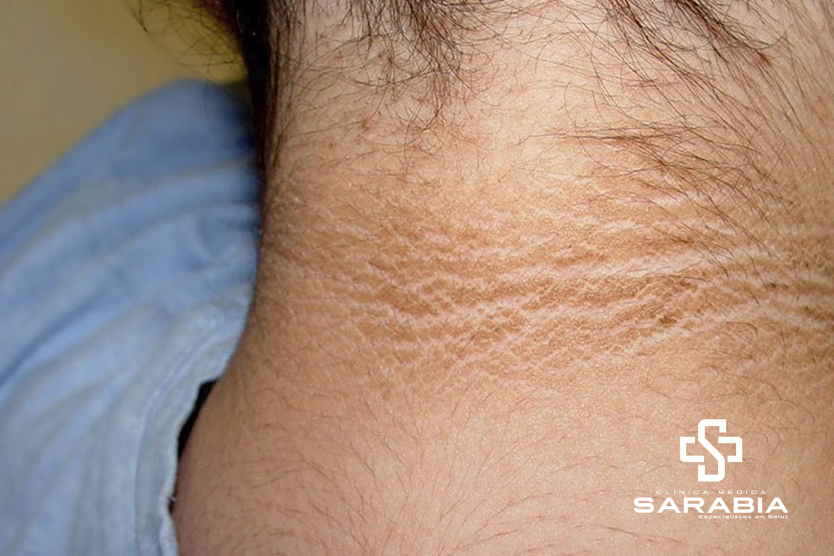 Acantosis Nigricans consulta en Tehuacan