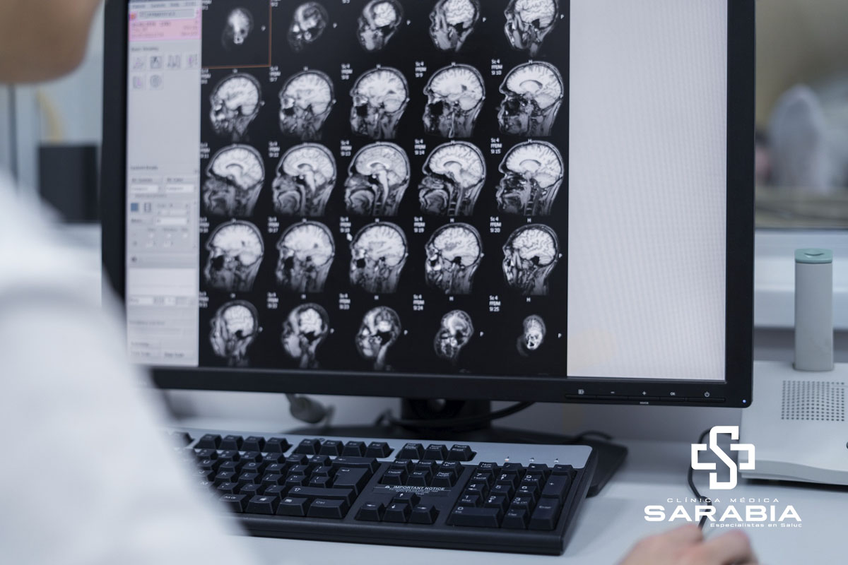 Aneurisma Cerebral en Tehuacán