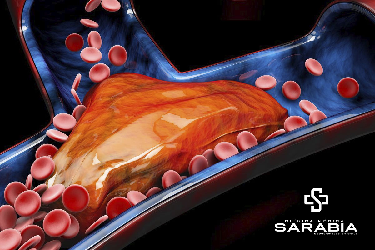 Colesterol Alto especialista Tehuacan