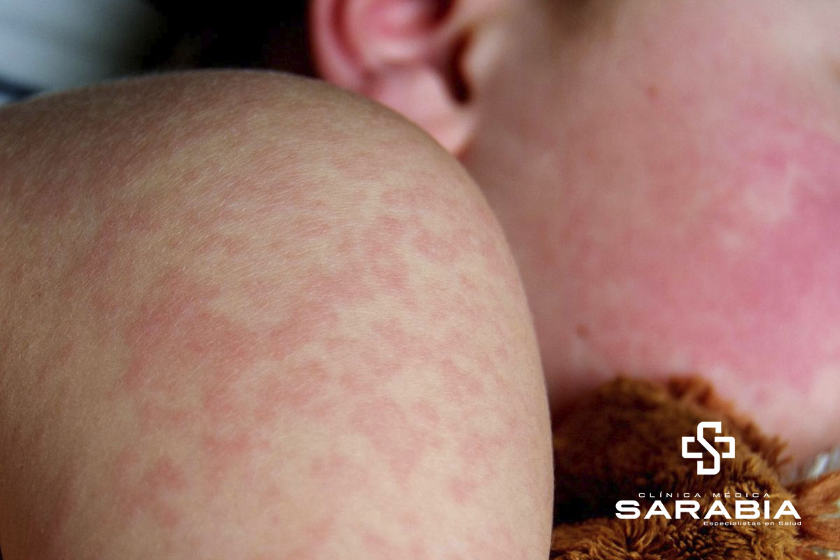 Enfermedad de Kawasaki Tehuacan